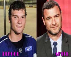 Liev Schreiber before surgery